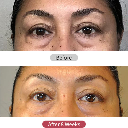 SOLOREDLIGHT™ LED Eye Rejuvenator | Anti-Aging, Fine Lines & Wrinkle Reduction, Mood & Sleep Improvement