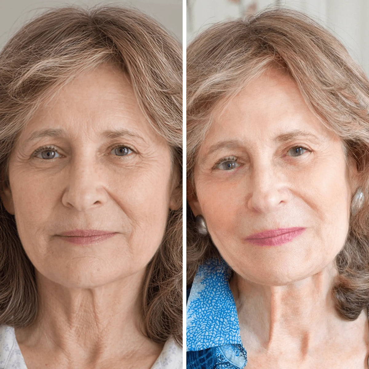 led-face-mask-before-after-1.webp
