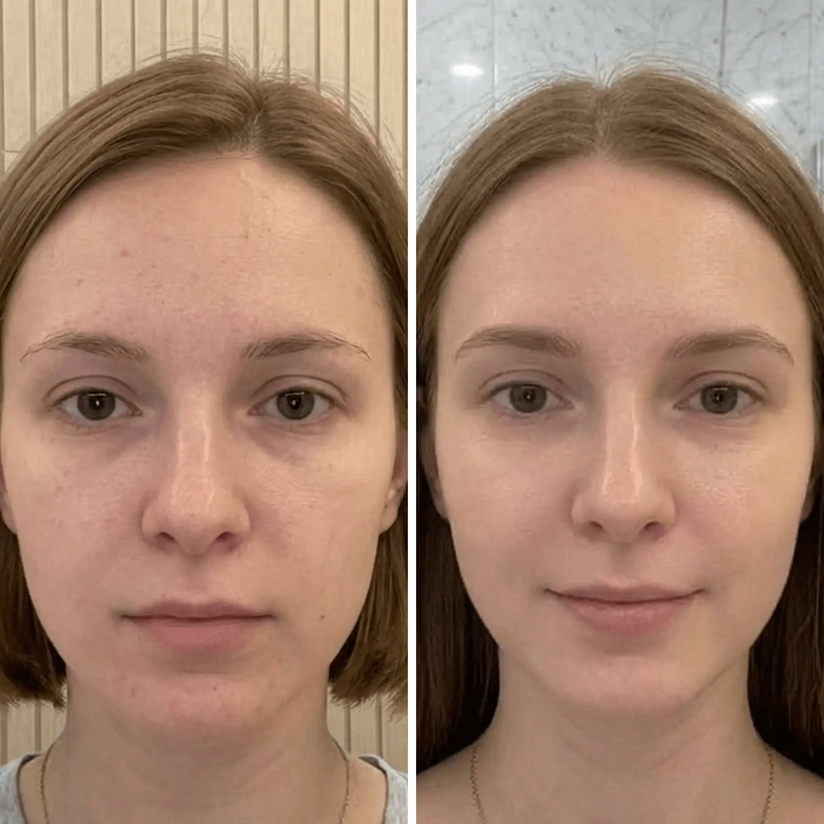 led-face-mask-before-after-2.webp