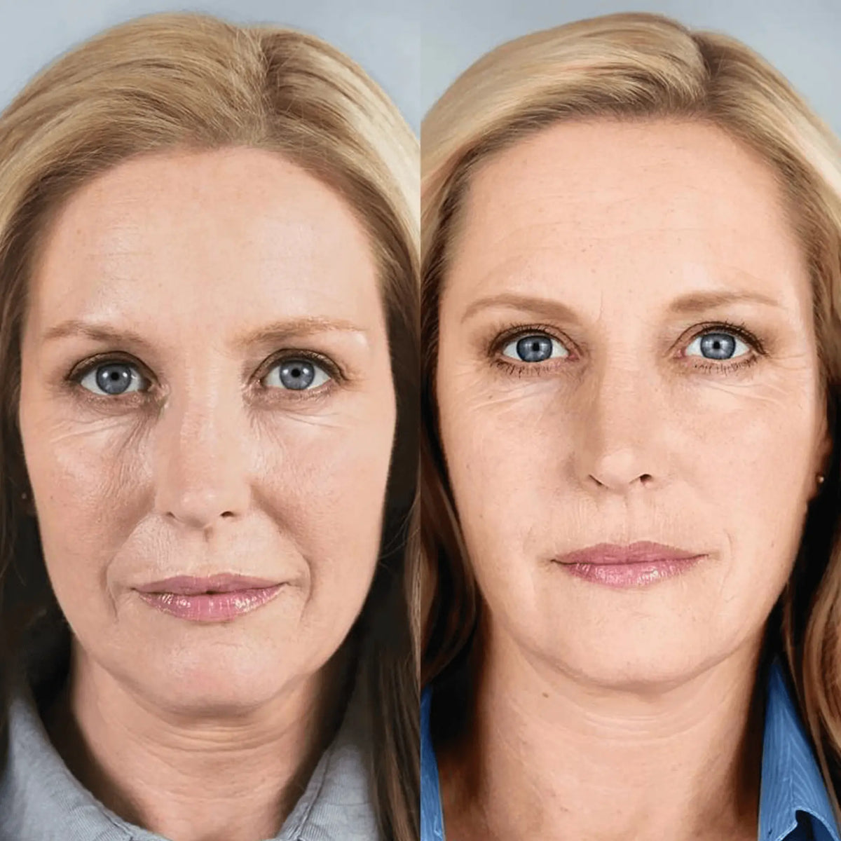 led-face-mask-before-after-3.webp